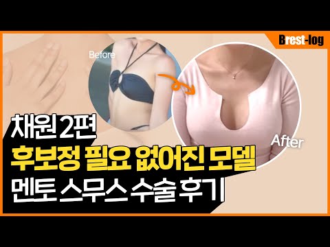 [채원] 가슴성형 브이로그 2편 I 1일차 부터 1달차 후기 I 가슴 A컵에서 D컵되고 달라진점 | 윈느성형외과 라벨윈느 유튜브 영상