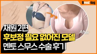 [Chaewon] 隆胸 Vlog 第2集 — 术后1天到1个月罩杯变化记录 | UNE 整形外科 — La Belle Une 视频频道