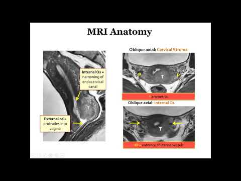 International Cancer Imaging Society Course Oct 17. Imaging uterine tumors, Alberto Vargas