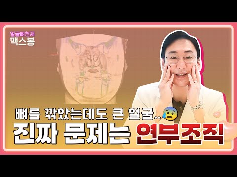 얼굴뼈를 깎아도 큰 얼굴..?! 진짜 문제는 연부조직!!