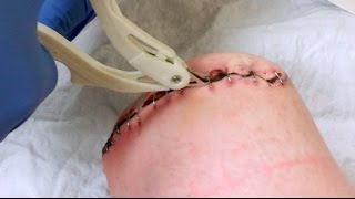 Staple Removal Post Amputation