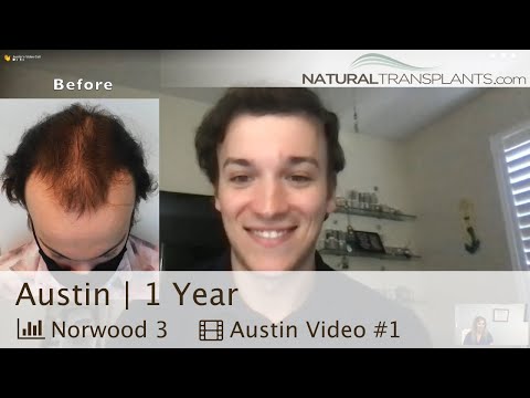 1 Year later Austin's hair restoration is an amazing...