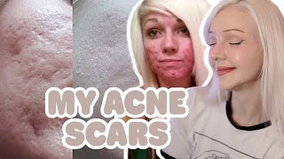 How I Got Rid Of My Acne Scars! (Before + After Pictures) My Experience With Acne and Scars