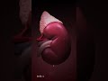 What Could Cause Kidney Stones Animation