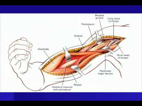 Humeral Shaft Fracture- Open Plating Strategies