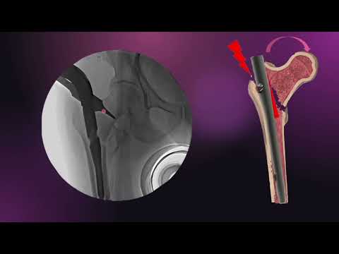 Wedge Effect in Trochanteric Fractures/ IT fractures/ Proximal femur fractures