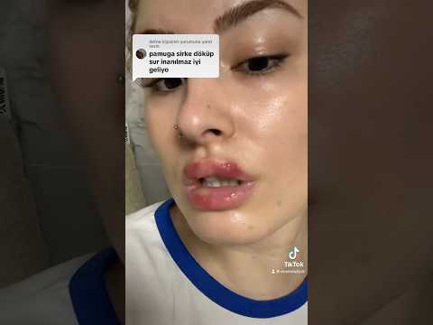 I'm trying to get rid of my cold sores, I don't know how many parts #ecemaakyol #cold sores