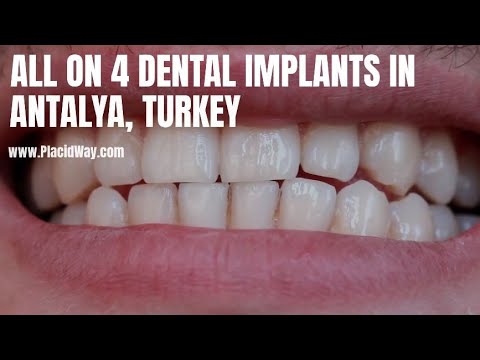 All on 4 Dental Implants in Antalya, Turkey