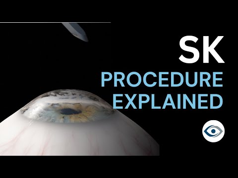 Superficial Keratectomy (SK) Procedure Explained | Precision Cornea Centre