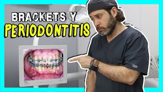 Cuando⛔️NO⛔️ USAR BRACKETS. Llevar ORTODONCIA en PACIENTES PERIODONTALES ¿es posible🤔