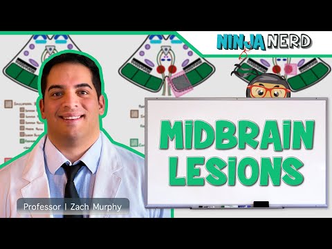 Stroke Syndromes MCA ACA ICA PCA Vertebrobasilar Artery Strokes Pathophysiology