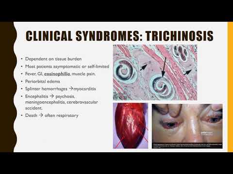 a trichinella betegség neve