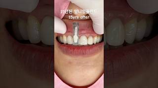 15년된 앞니심미임플란트👍 #dental #dentist #smile  #dentistry #esthetic