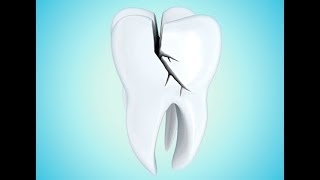 Micro Fracturas... Un Enemigo Silencioso