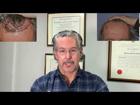 Do hair transplants LAST??? 13 years out, fine hair, patient now 74. 1800 grafts Dr. Lindsey thumbnail