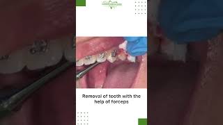Orthodontics tooth extraction #shorts (2022)