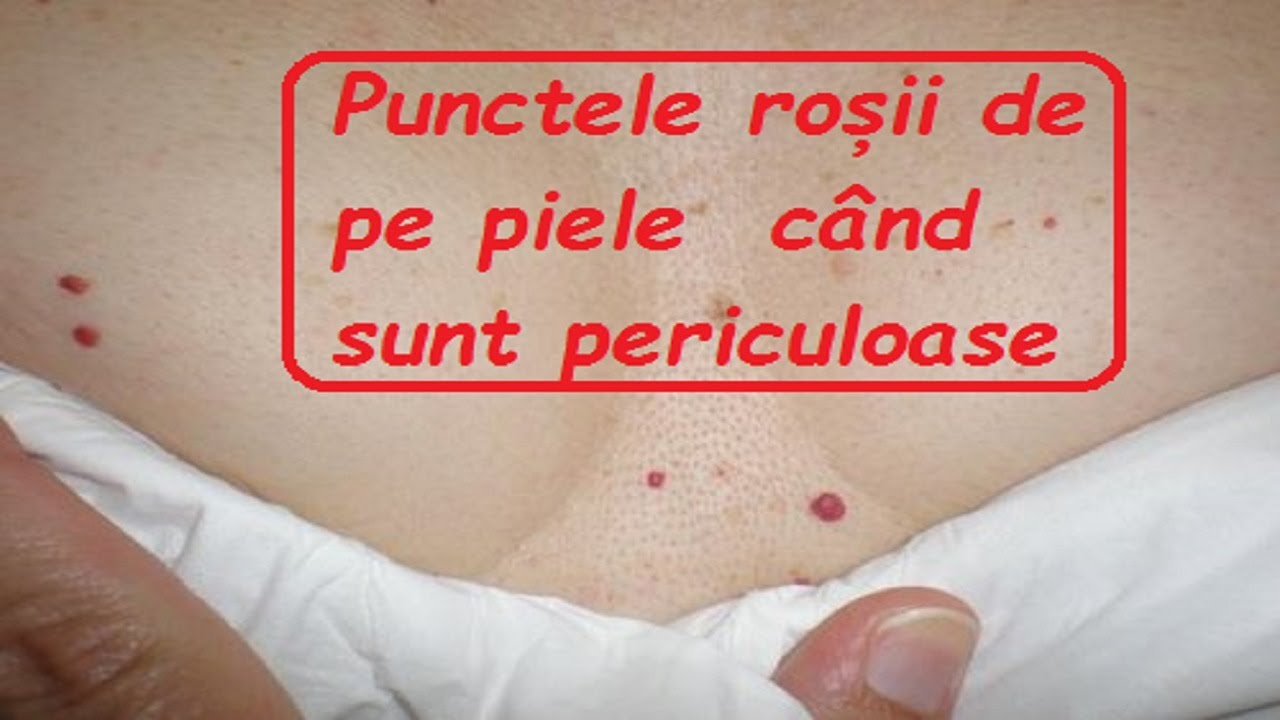 ??Punctele ro?ii de pe piele – când sunt periculoase??