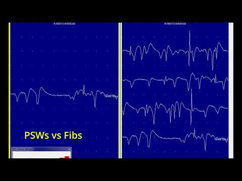 Positive sharp waves and fibrillations, PSW, PSWs, Fibs