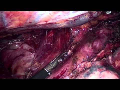 Thoracoscopic Esophagectomy With Radical Lymphadenectomy