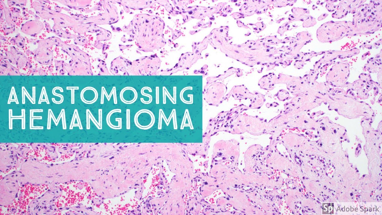 Anastomosing Hemangioma 101...Explained by a Soft Tissue Pathologist