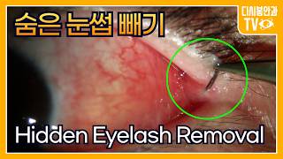 Download lagu Hidden Eyelash Removal mp3