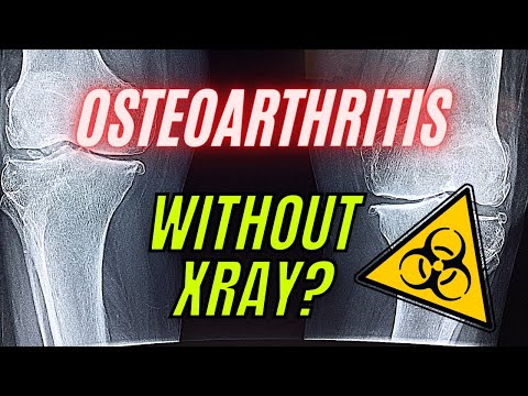 Osteoarthritis arthrosis kezelése