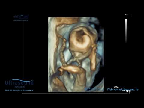 Scan of the Week: 19 Week Advanced Early Scan - Ultrasound Ireland