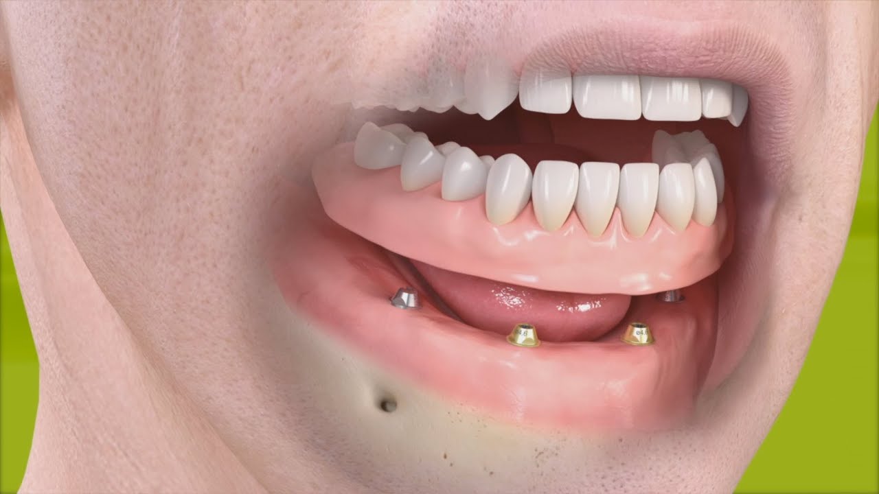 Watch Straumann - Restauración fija sobre 4 implantes, inclinados en cuadrante posterior Now Straumann - Restauración fija sobre 4 implantes, inclinados en cuadrante posterior