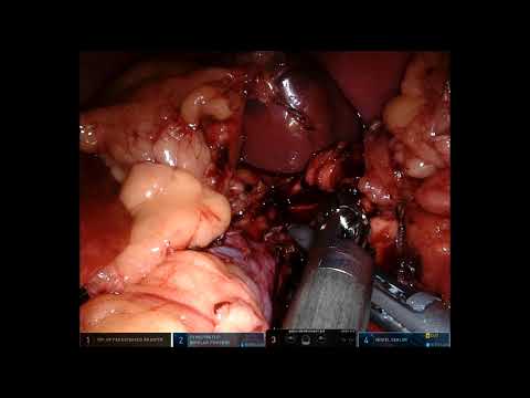 Robotic Spleen Preserving Distal Pancreatectomy