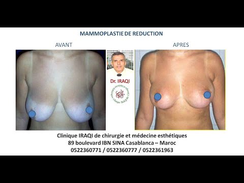 comment trouver un bon chirurgien rhinoplastie