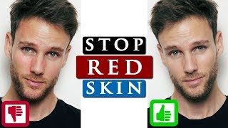 How to get rid of REDNESS on your FACE | 3 SKIN CARE TIPS