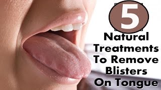 5 Home Remedies to Get Rid of Tongue Blisters Fast | By Top 5.
