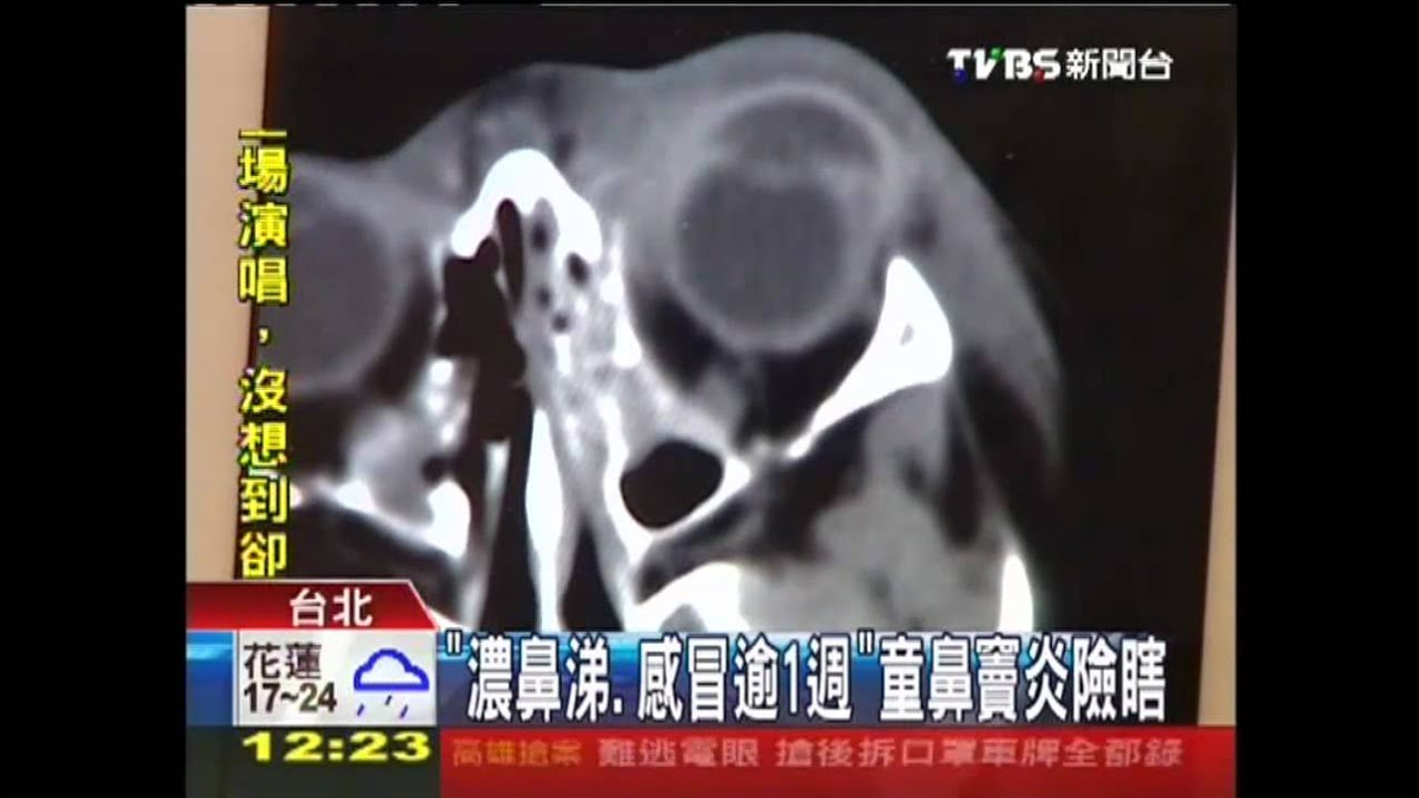 「濃鼻涕、感冒逾1週」 童鼻竇炎險瞎