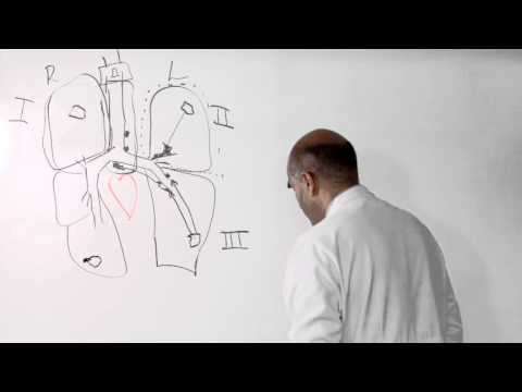 Stage 3 and Stage 4 Lung Cancer