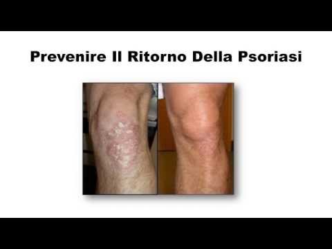 Unguento di dermatite di atopic nonormonale Ultima medicina di psoriasi