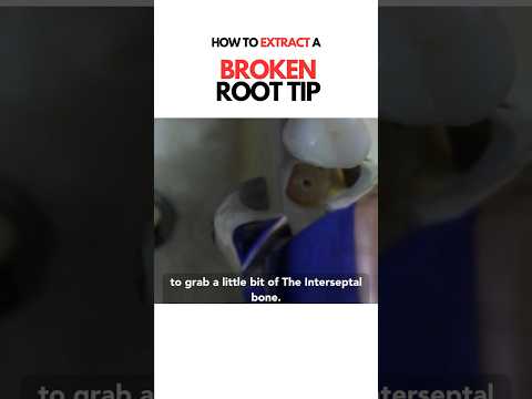 How to Extract Root tips - Maxillary root difficult extractions