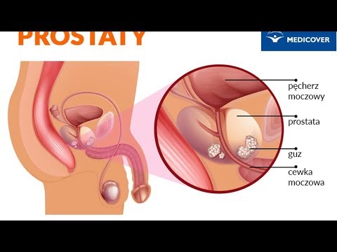 A prosztatitával kapcsolatos fejlesztések