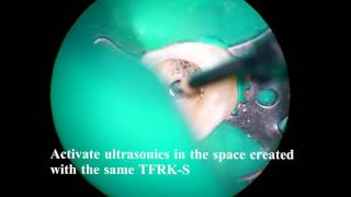 17482bf ultrasonics difficult case w perf and ledge