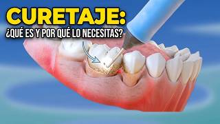 CURETAJE: ¿Qué es y por qué lo necesitas?