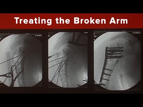 The Broken Arm: How are the Most Common Injuries Treated?