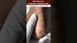 Wart Removal Treatment at Skinaa Clinic #Wart #removal #skinaaclinic #skinaa #skinaa_clinic