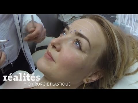 Injection de toxine botulique : tiers supérieur du visage - Botulinum Toxin Injection