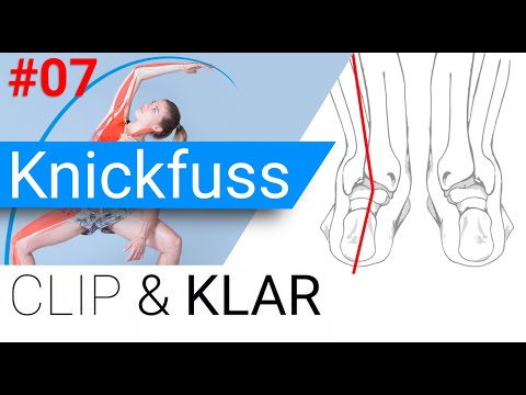 Knickfuss erklärt - Ferse aus dem Lot