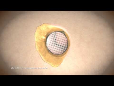 Covidien Patch Ventral Animation PCOVP