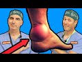 Achilles Tendinitis: Causes and Treatments