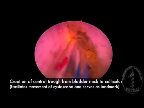 Laser Vaporization for BPH