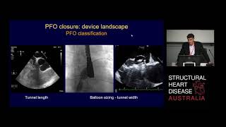 PFO Closure: Device Landscape – Prof David Muller