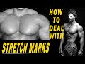 All ABOUT STRETCHMARKS - Jitender Rajput