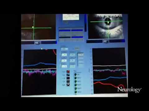 Supranuclear gaze palsy and horizontal ocular oscillations in Creutzfeldt-Jakob disease