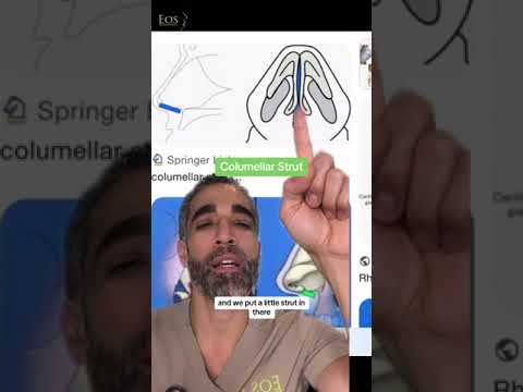 Types of Grafts in #rhinoplasty? #rhinoplastybeforeandafter #rhinoplastyexpert #nosejob